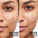 The Inkey List Succinic Acid Acne Treatment