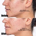 Sunday Riley Peacekeeper Azaleic and Salicylic Acid Acne Treatment Serum