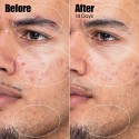 Sunday Riley Peacekeeper Azaleic and Salicylic Acid Acne Treatment Serum